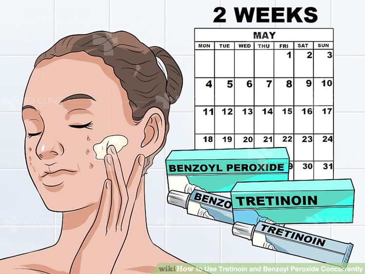 Benzoyl Peroxide 2,5% được bác sĩ da liễu khuyến nghị là cách trị mụn nhanh hiệu quả tại nhà.