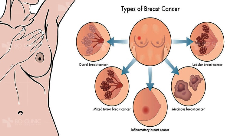 Những nốt mụn mới mọc trên ngực trị mãi không hết có thể là dấu hiệu cảnh báo bệnh ung thư vú ở nữ và cả nam giới.