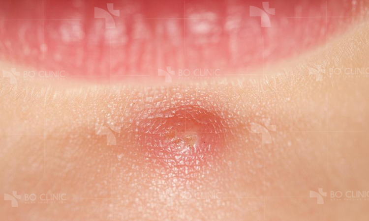 Sưng tấy, ngứa và đau rát là những triệu chứng rất khó chịu khi mụn nổi dưới da.