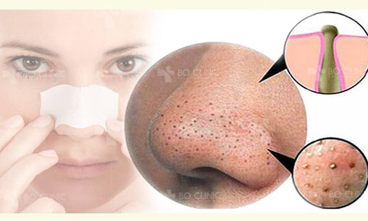 Trị mụn đầu đen vùng mũi: Lợi ích và tác hại của từng phương pháp